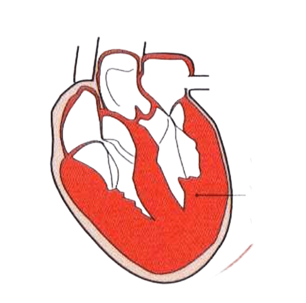 Schematische Darstellung: Hypertrophe Kardiomyopathie